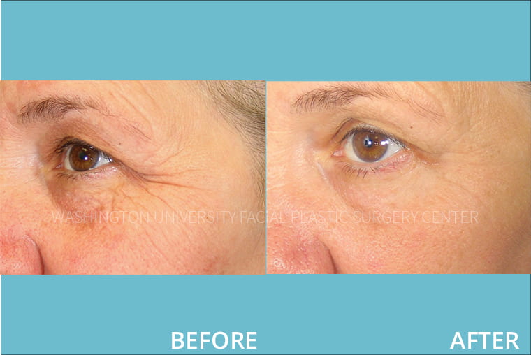 Laser Resurfacing - Eye Before and After