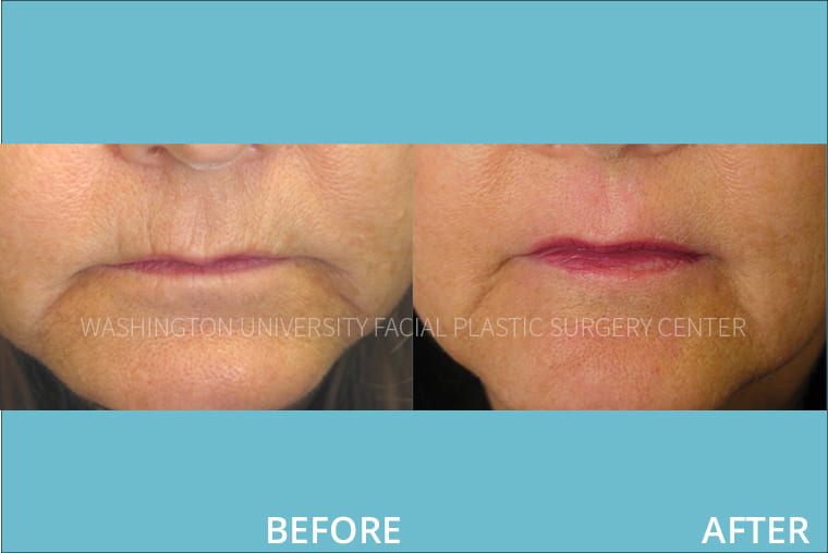 Laser Resurfacing - Mouth Before and After