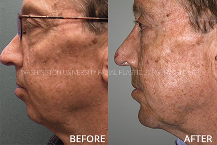 Chin Implant Before and After