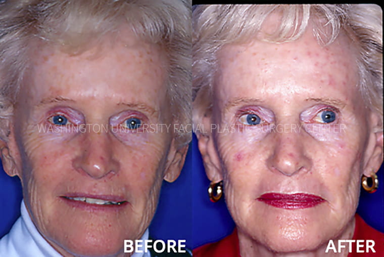 Facial Peel Before and After