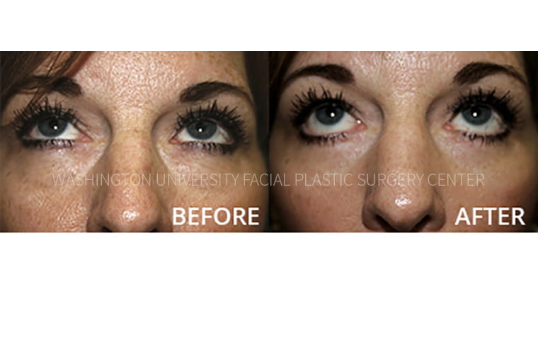 Eyelid Before and After
