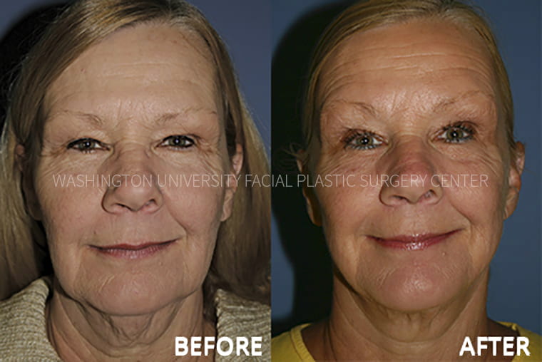Mini Facelift Before and After