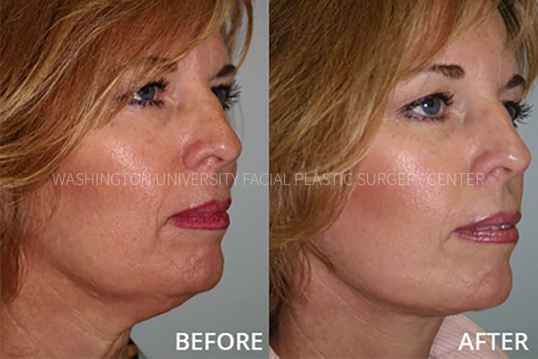 Neck Lift Before and After
