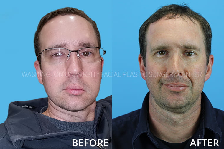 Facial Nerve Surgery Before and After