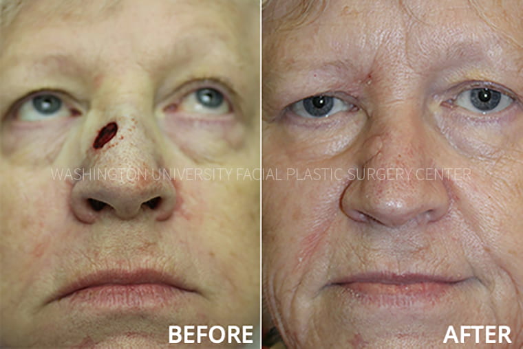 Nose Reconstruction Before and After