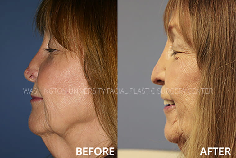 Nose Reconstruction Before and After