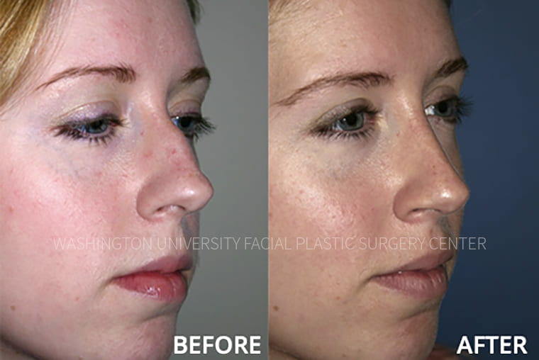 Nose / Rhinoplasty Before and After