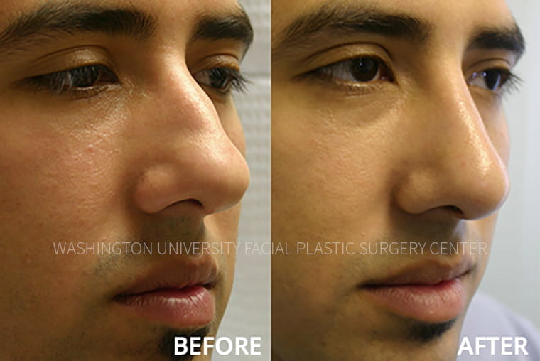 Nose / Rhinoplasty Before and After