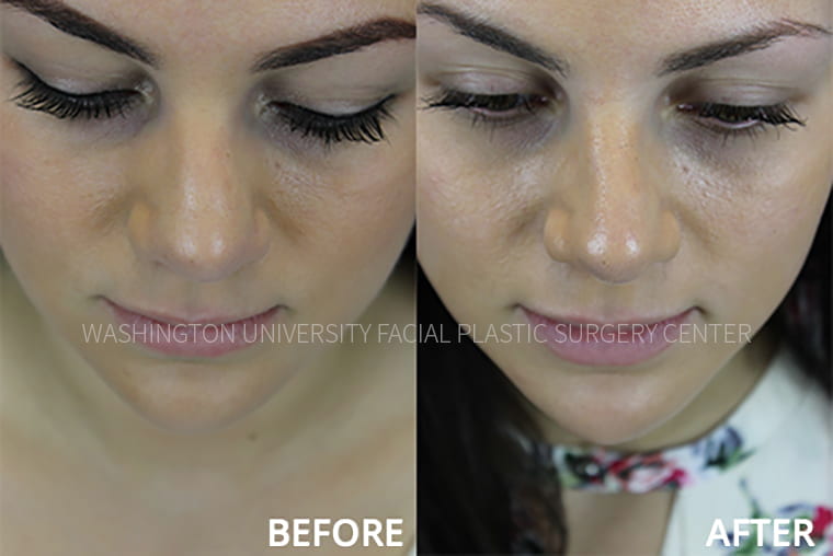 Septorhinoplasty Before and After