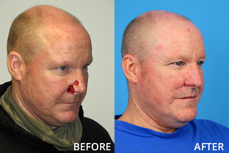 Nasal Reconstruction Before and After