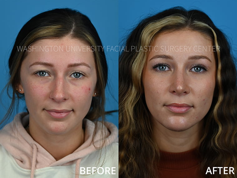 Rhinoplasty Before and After - Front View