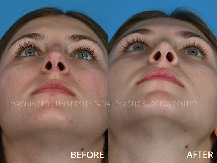 Rhinoplasty Before and After - Base View