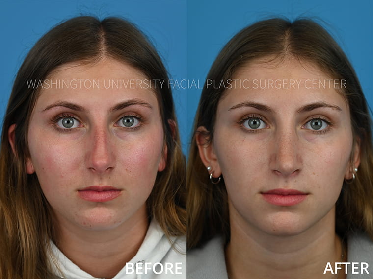Rhinoplasty Before and After - Frontal View