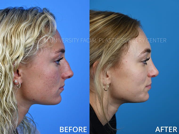 Rhinoplasty Before and After - Lateral View
