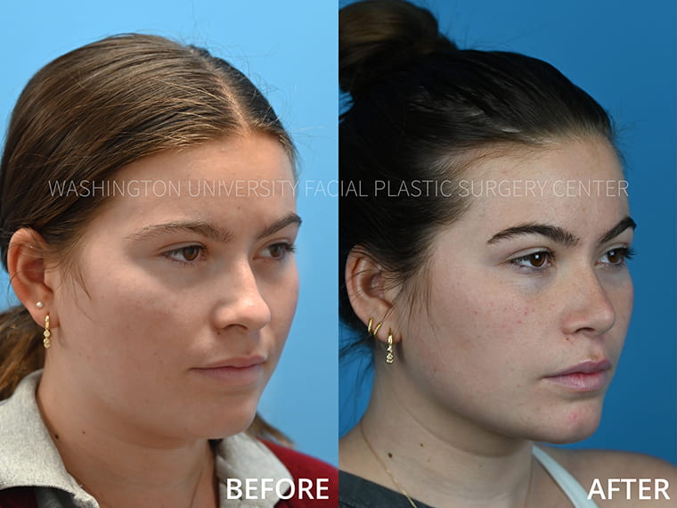 Rhinoplasty Before and After - Right Oblique View